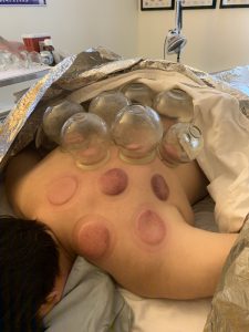 Ira Wahrman acupuncturist performing cupping for upper back and shoulder pain