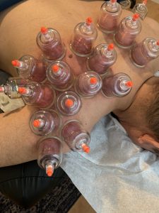 Ira Wahrman acupuncturist performing cupping for shoulder and neck pain