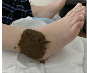 poultice for ankle sprain